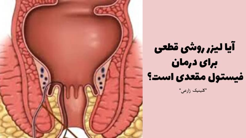 روشهای درمان فیستول مقعدی با لیزر