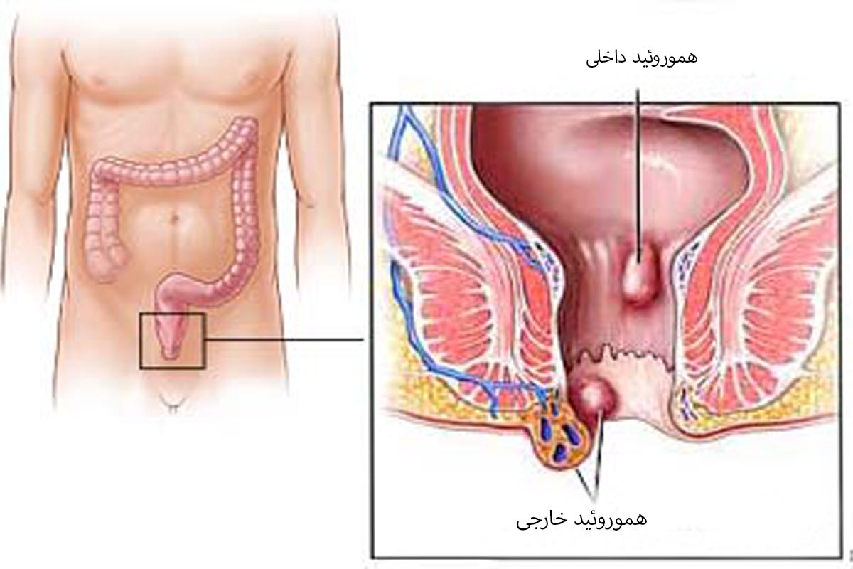هموروئید با بواسیر چه فرقی دارد؟