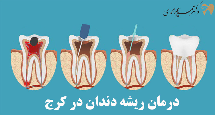 درمان ریشه دندان در کرج