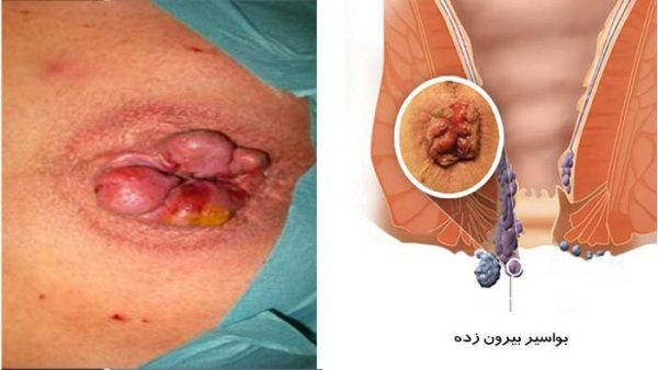 بیرون زدگی بواسیر داخلی