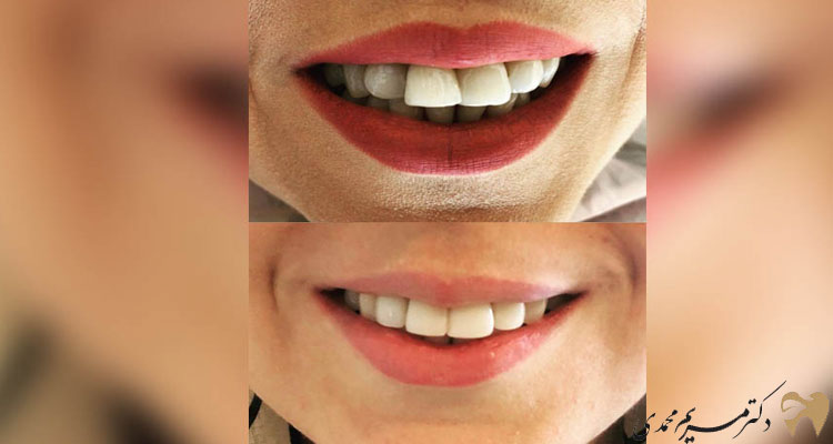 عكس كامپوزيت دندان قبل و بعد