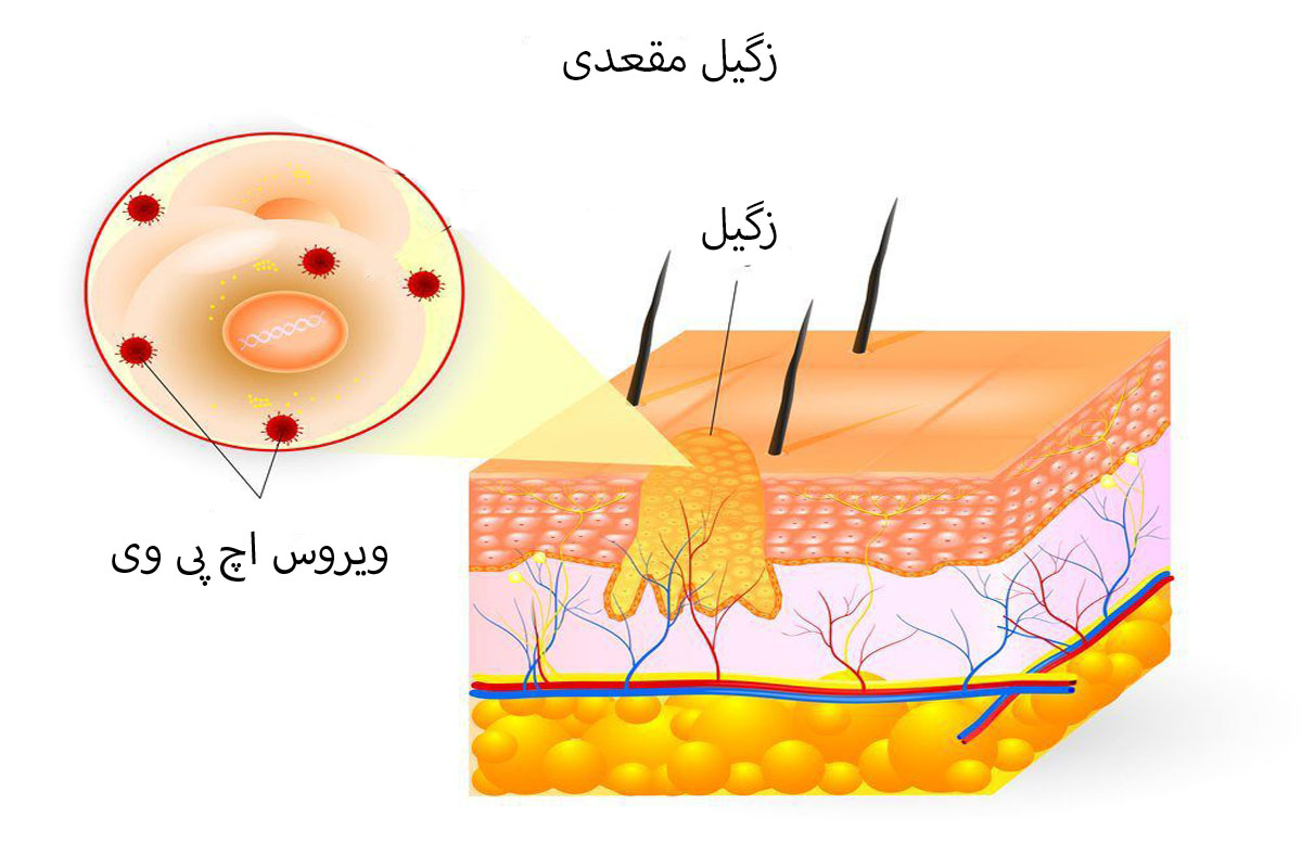 تصویر زگیل مقعدی