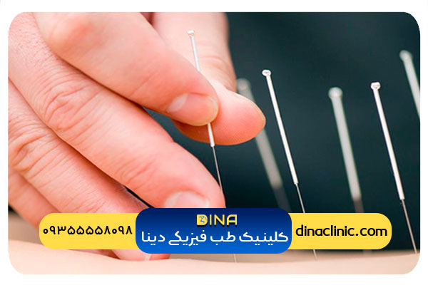 انجام طب سوزنی برای لاغری در نقاط حساس مچ پا