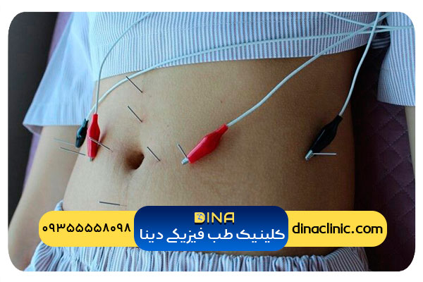 هزینه طب سوزنی در لاغری شکم چقدر است؟ | کلینیک دینا