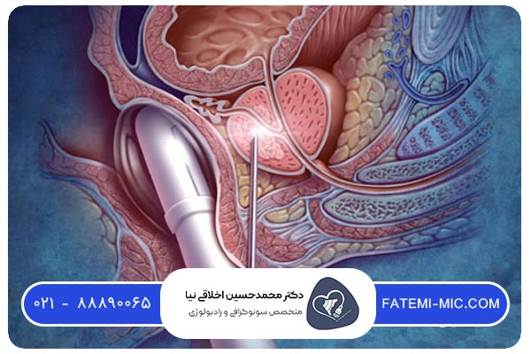 شیمی درمانی برای درمان سرطان پروستات | سونوگرافی و رادیولوژی فاطمی