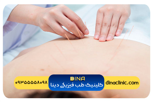 نکات مهم در انجام طب سوزنی برای دیسک کمر