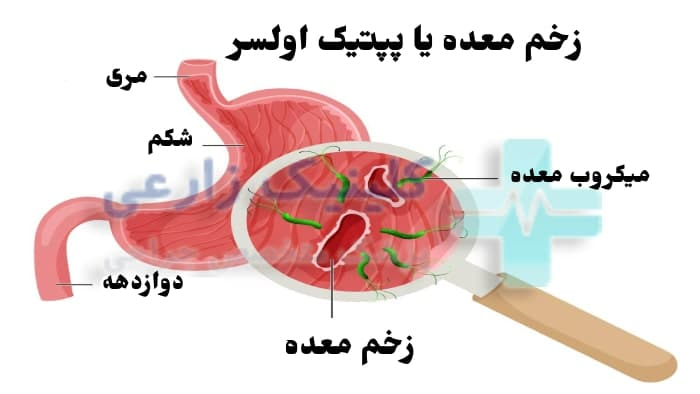 زخم معده چیست