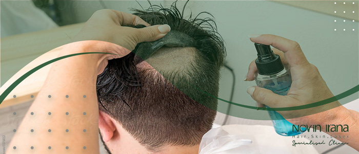 پروتز مو دائم