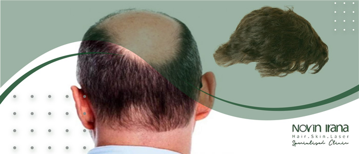 پروتز مو چیست